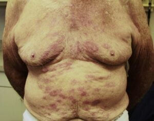 Read more about the article Leprosy Cases Surge in Florida and Southeastern United States, Raising Concerns for Endemic Presence